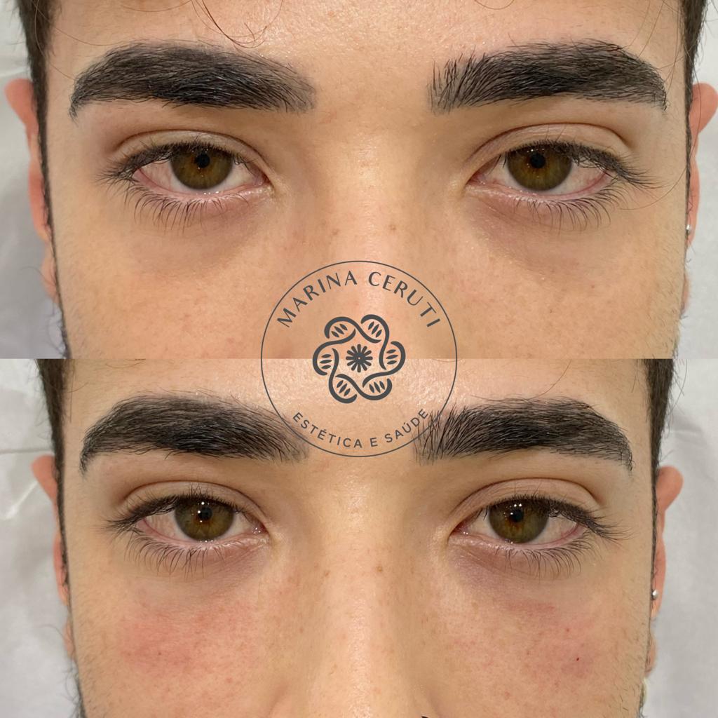 preenchimento facial olheiras